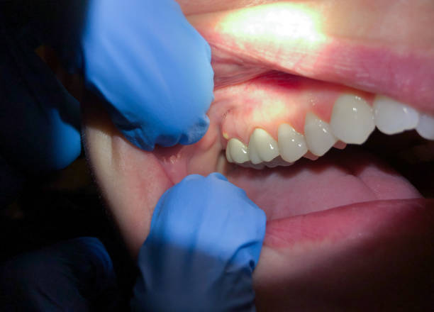 Best Tooth Infection Emergency Dentist  in High Bridge, WA